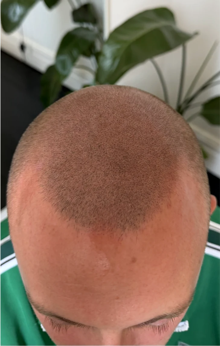 A client&rsquo;s crown after shaved-head SMP