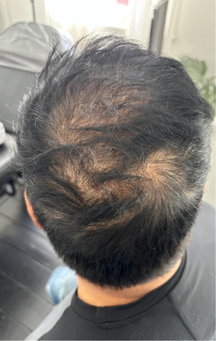 A client&rsquo;s thinning crown before density SMP
