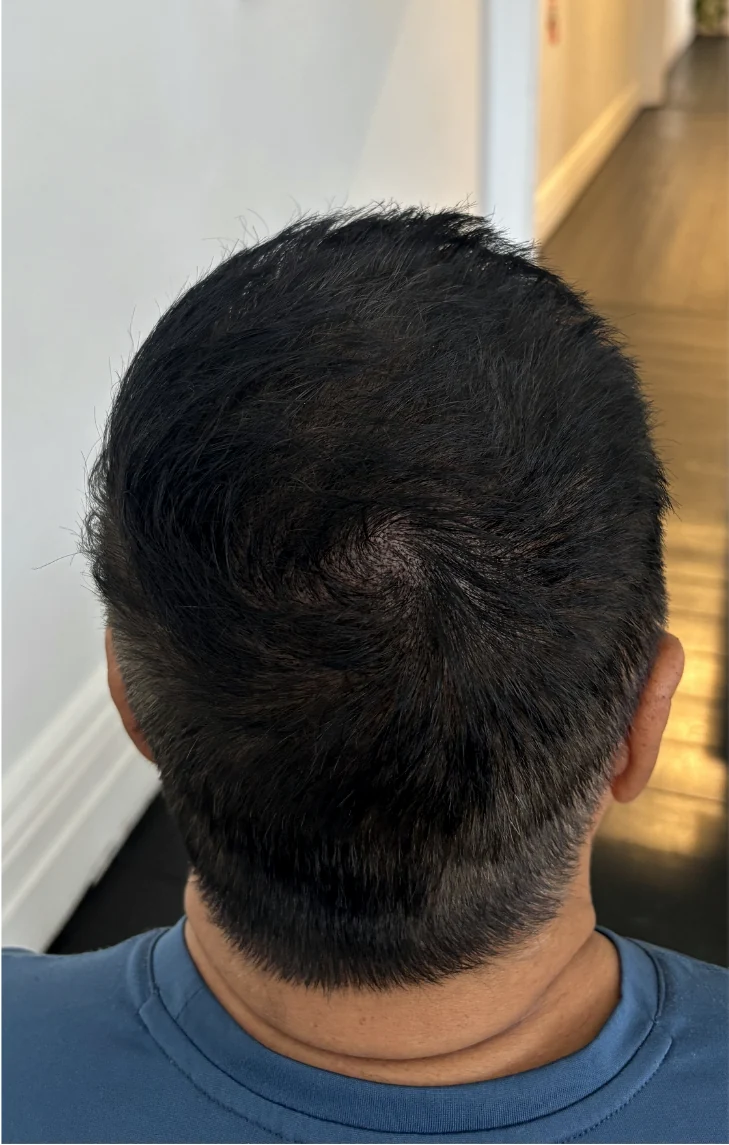 The same client after density SMP