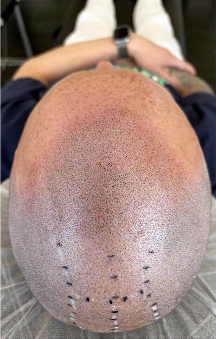 A shaved head finished with SMP