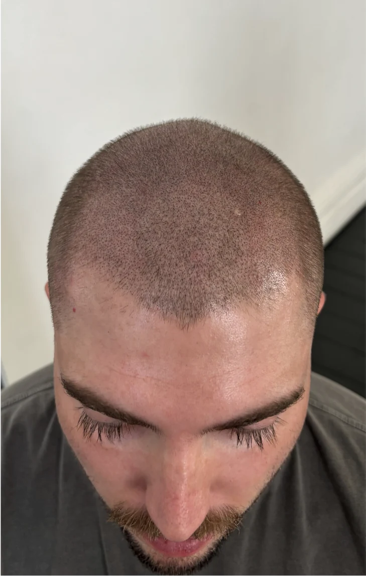 A client&rsquo;s crown after density SMP