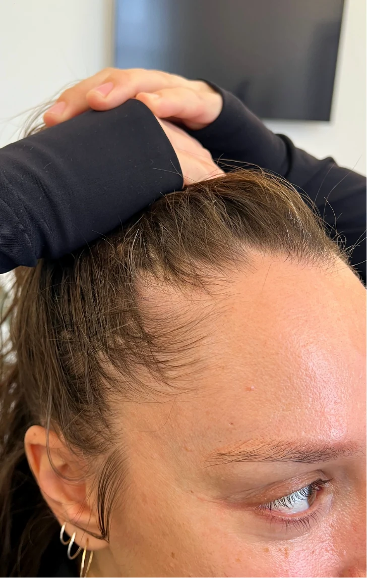 A client&rsquo;s receding hairline before MicroDensa