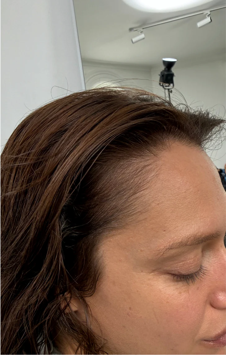 The same client after MicroDensa