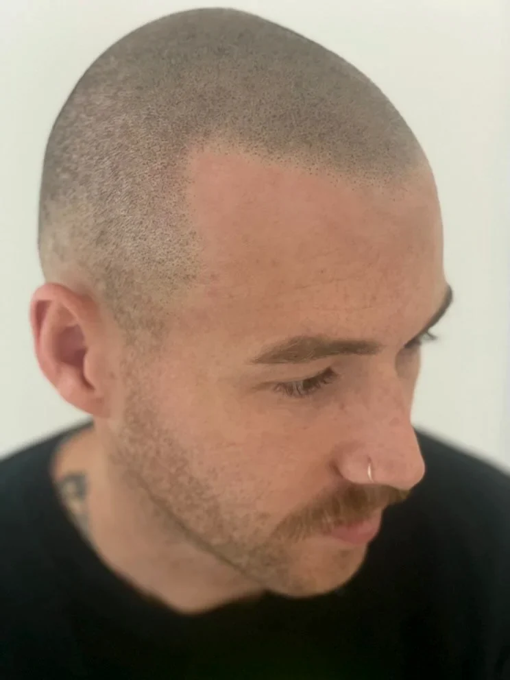 A close-up of a finished SMP hairline