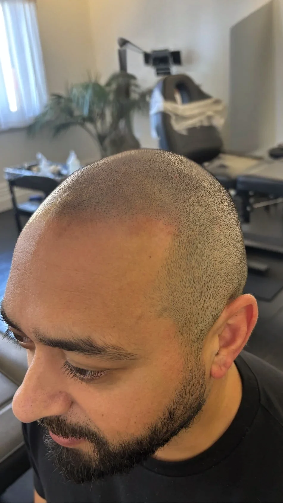A client&rsquo;s hairline in profile after SMP